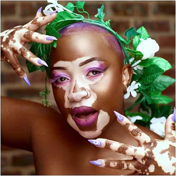 VITILIGO.jpg
